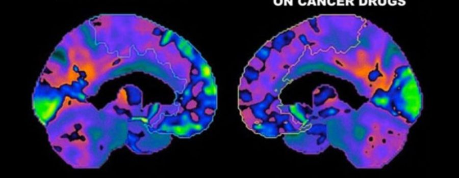 CANCER: Effects of ‘chemobrain’ seem to disappear after a few , The Boston Globe, Health and Science